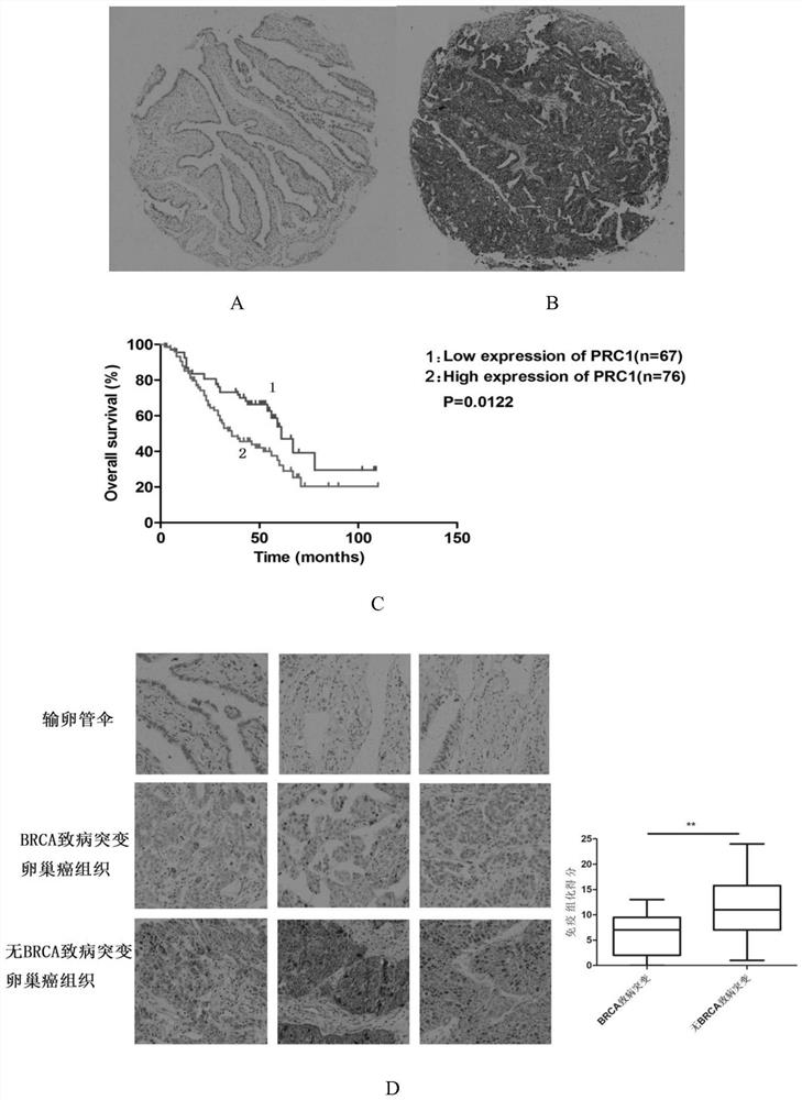 Markers for targeted therapy and prognosis in high-grade serous ovarian cancer