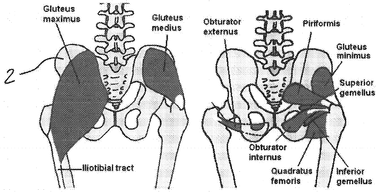 Coating for an implant