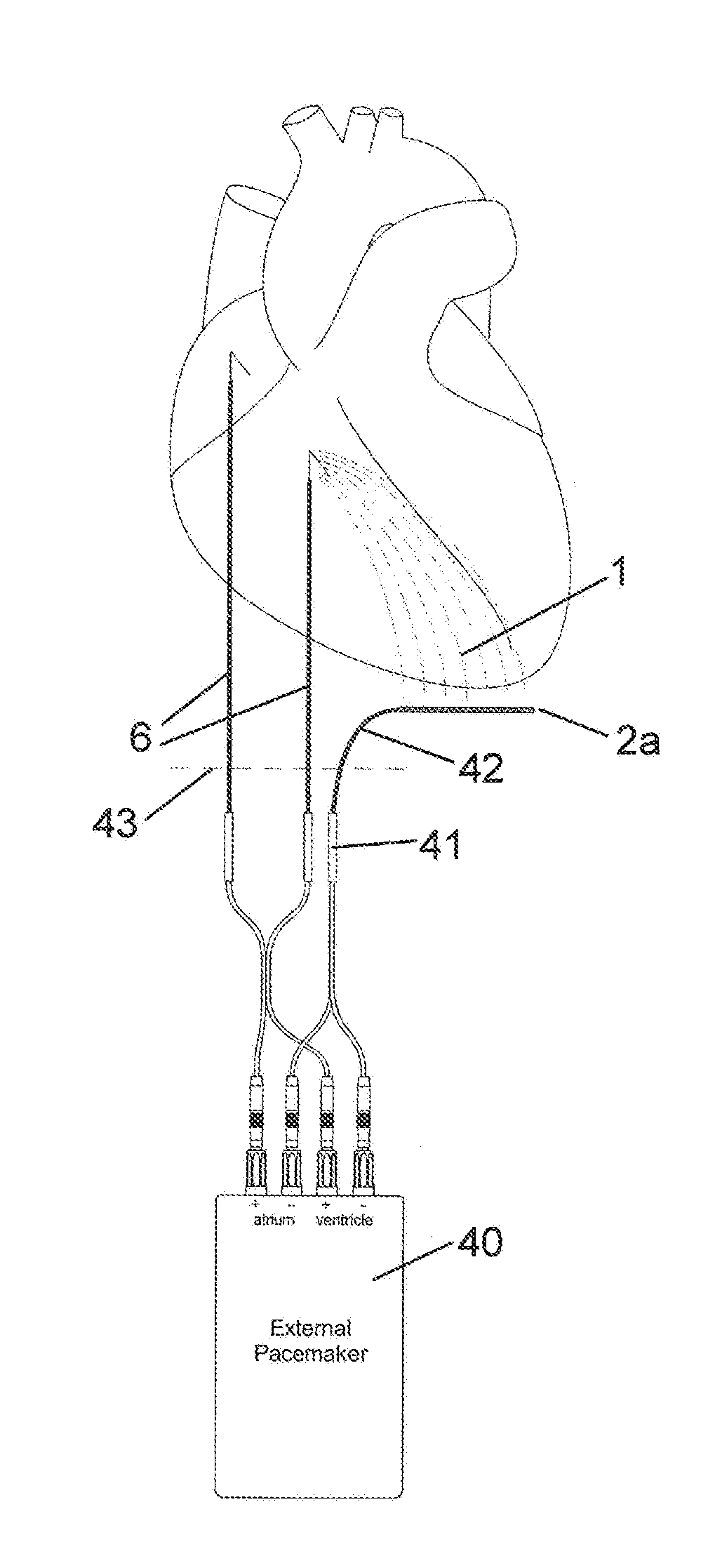 Implantable indifferent electrode