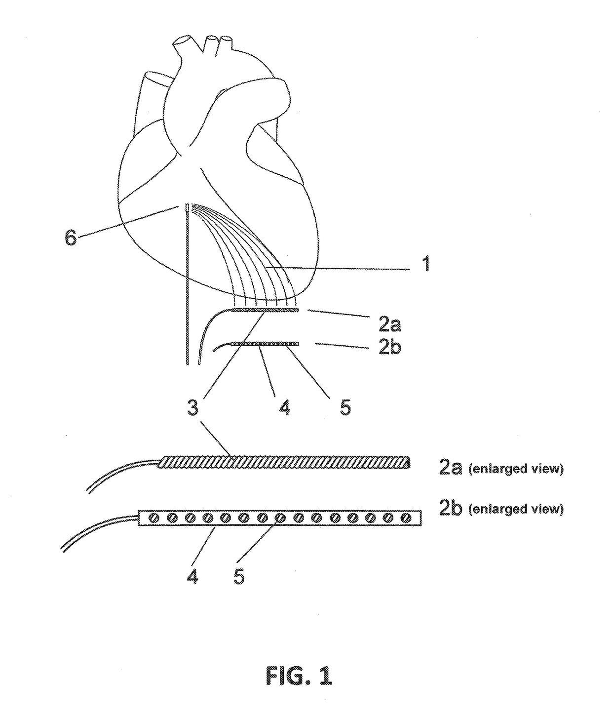 Implantable indifferent electrode