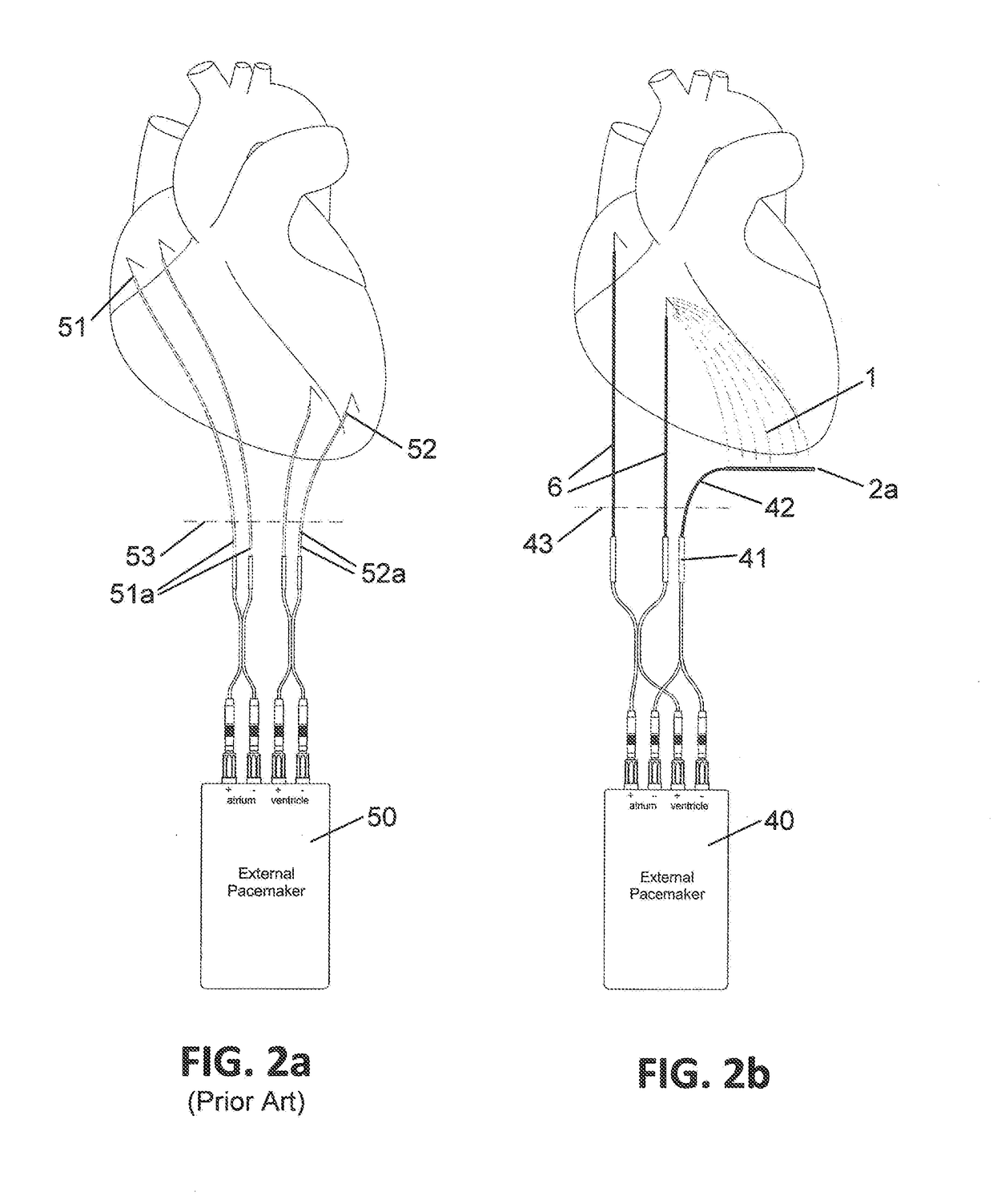 Implantable indifferent electrode