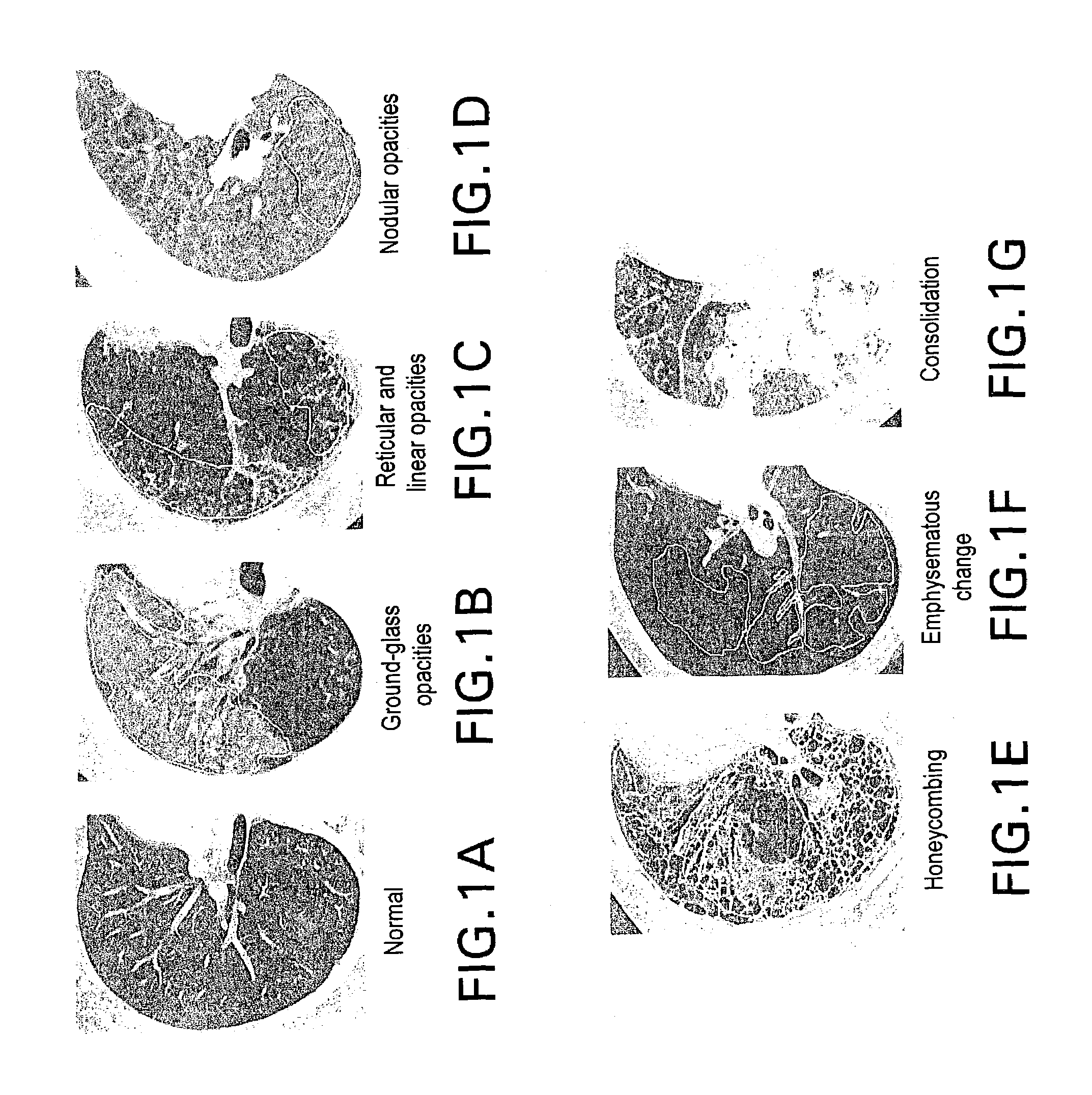 System and method for computer-aided detection and characterization of diffuse lung disease