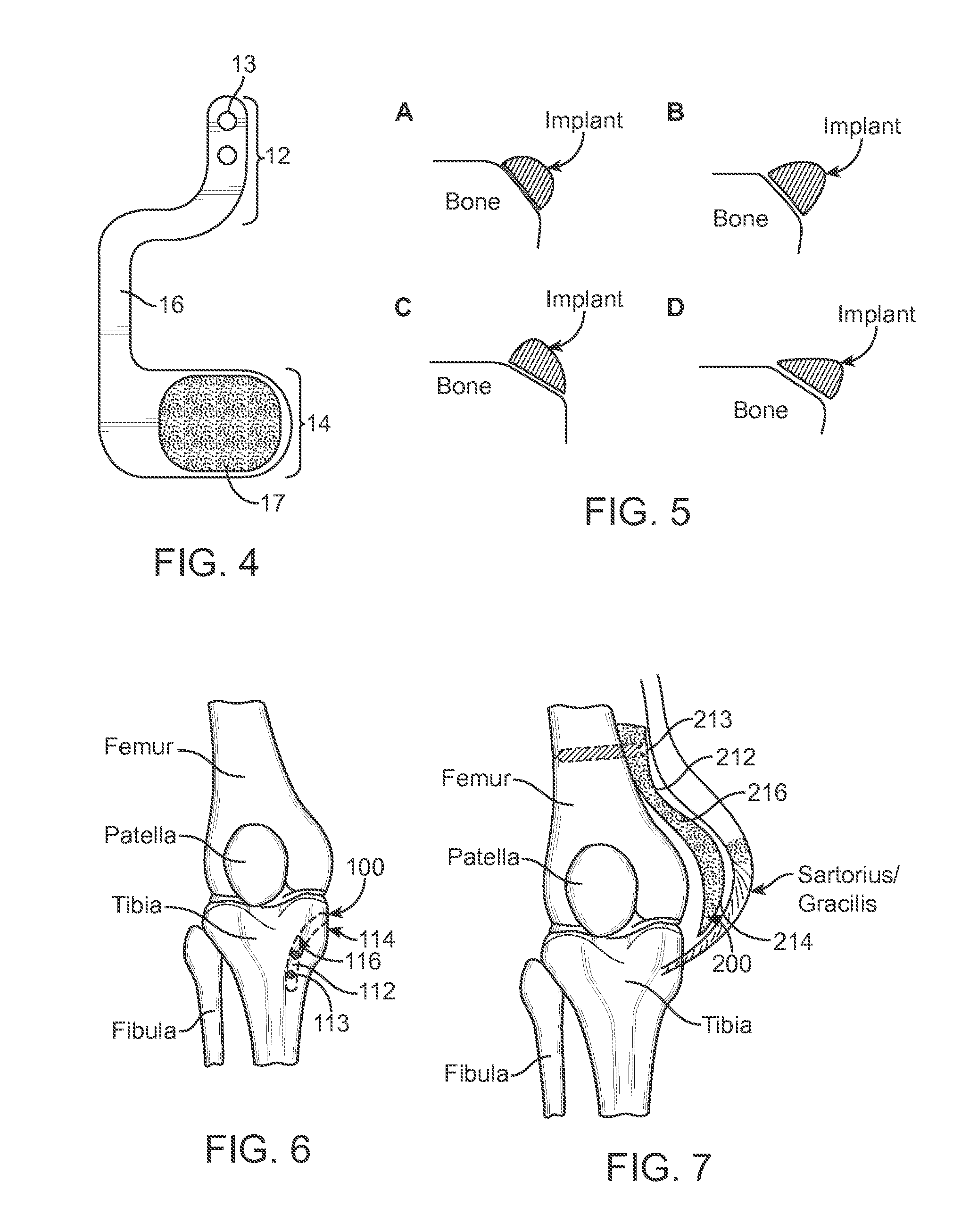 Method and Apparatus for Altering Biomechanics of the Articular Joints