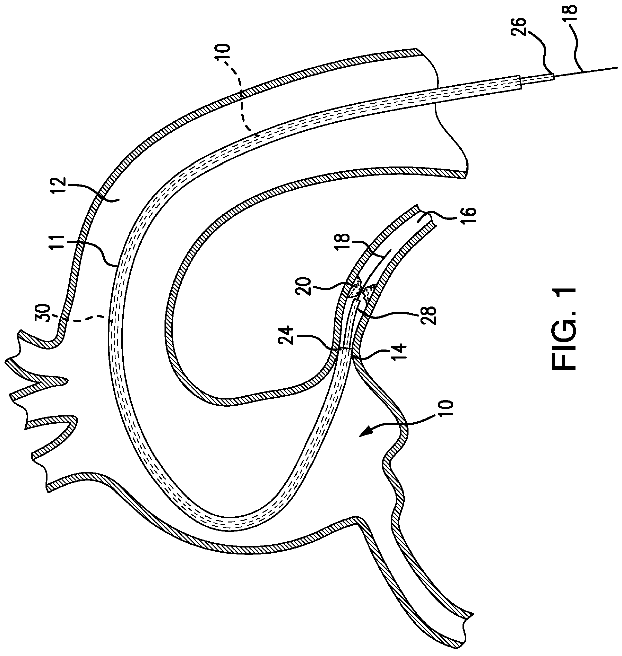 Guide catheter extension system with a delivery micro-catheter configured to facilitate percutaneous coronary intervention