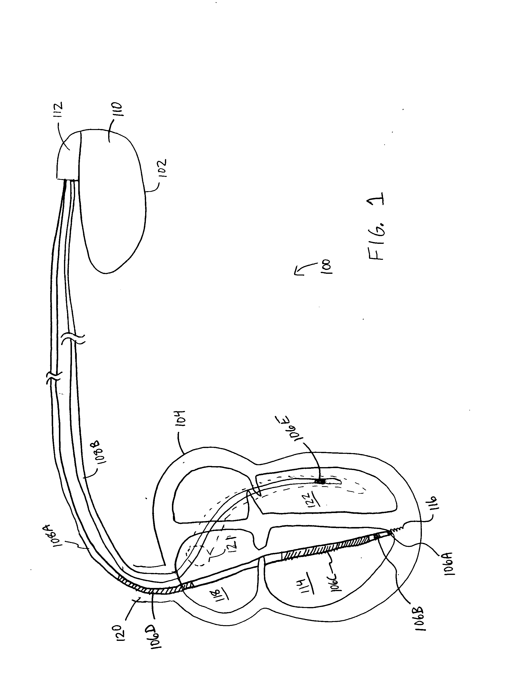 Semiconductor-gated cardiac lead and method of use