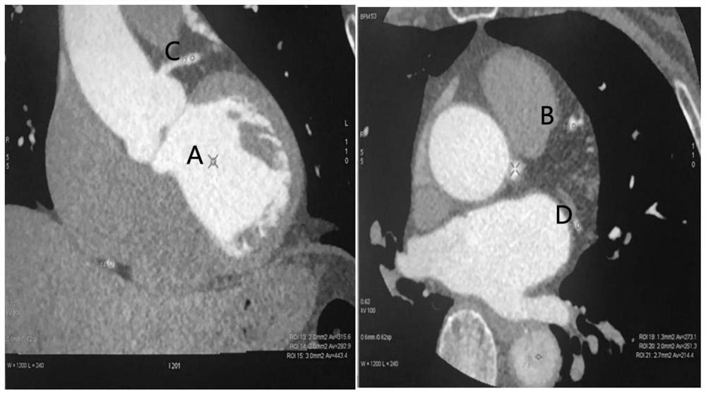 Application of ultra-low-amount contrast agent in coronary artery imaging of renal insufficiency patient