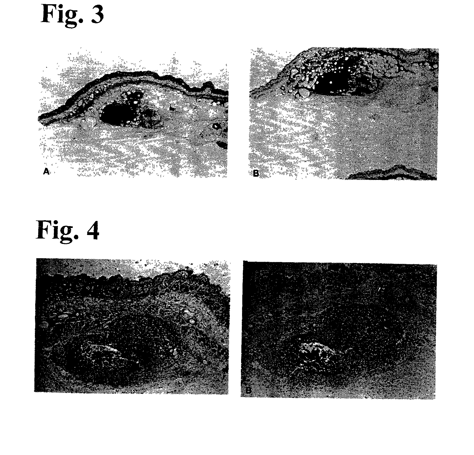 Method of manufacture of garlic extract for use as a preventive and therapeutic agent for human prostate and bladder cancers