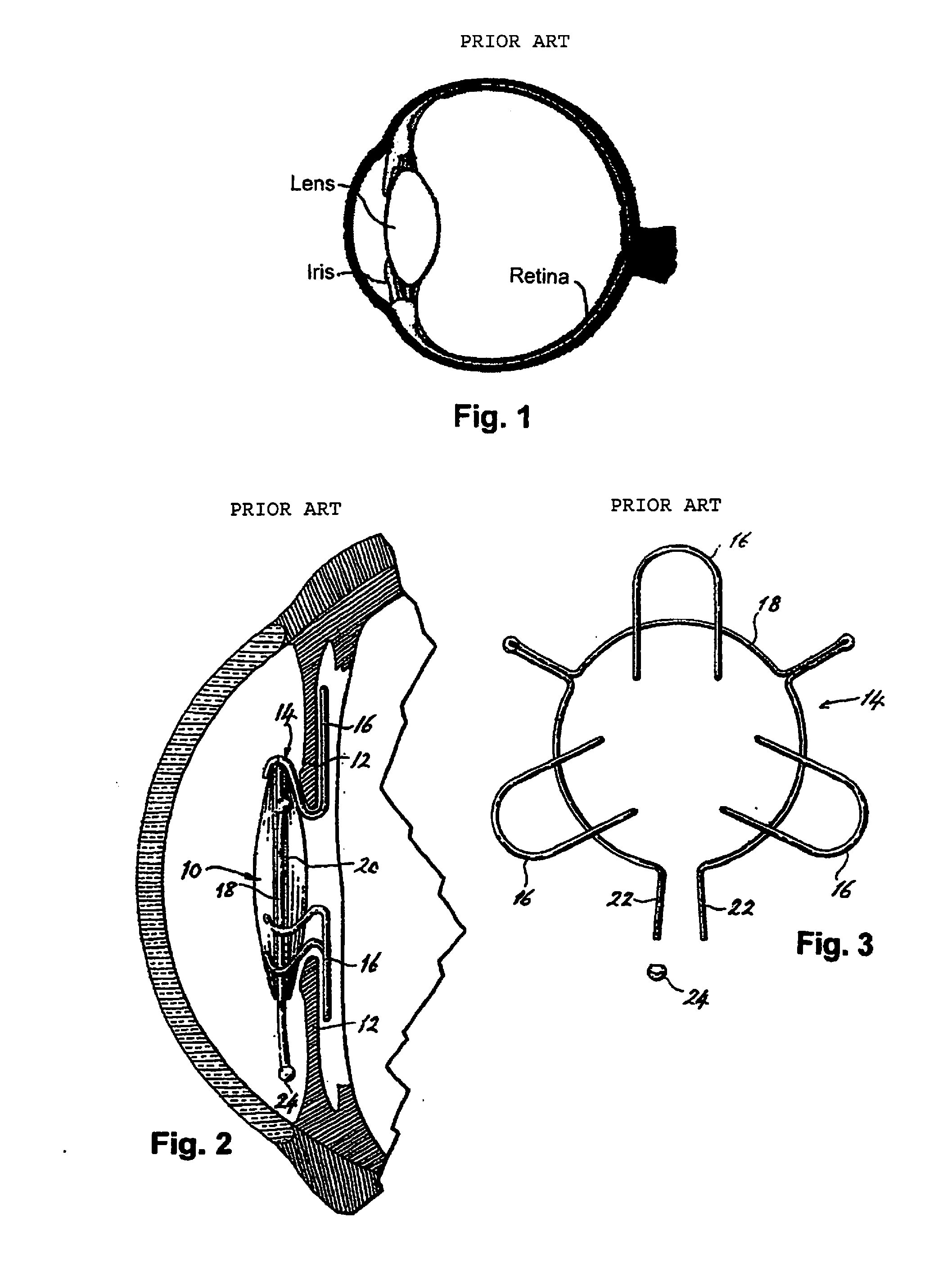 Intraocular implant and method for fixing same into an eye
