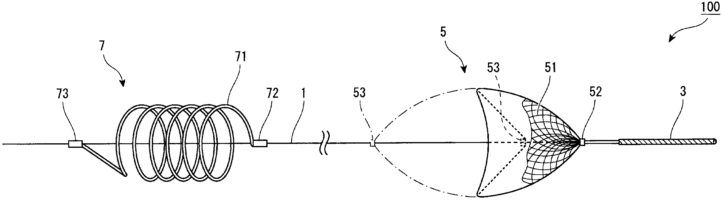 Embolic material excision trapping device