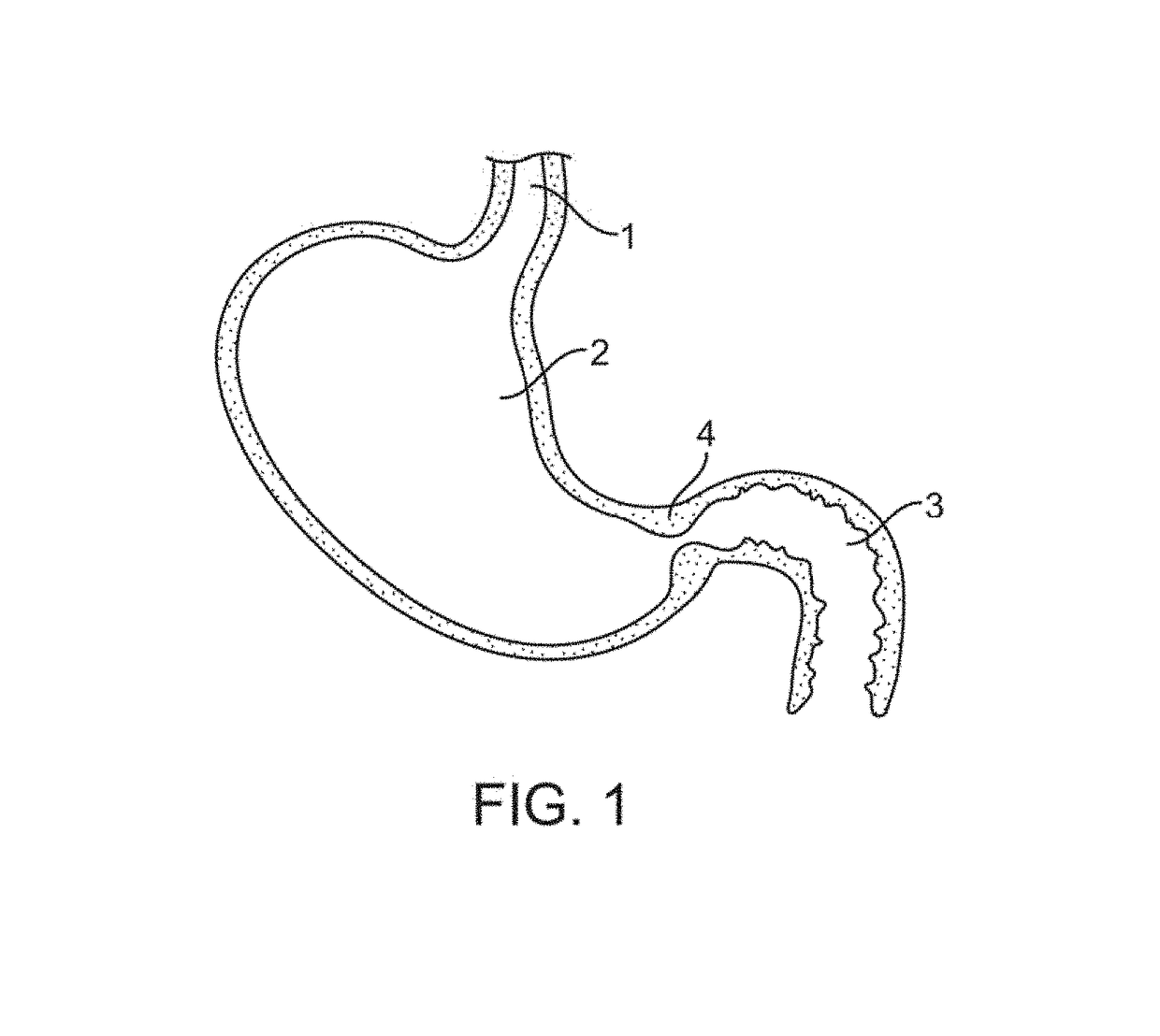 Devices and methods for gastrointestinal stimulation