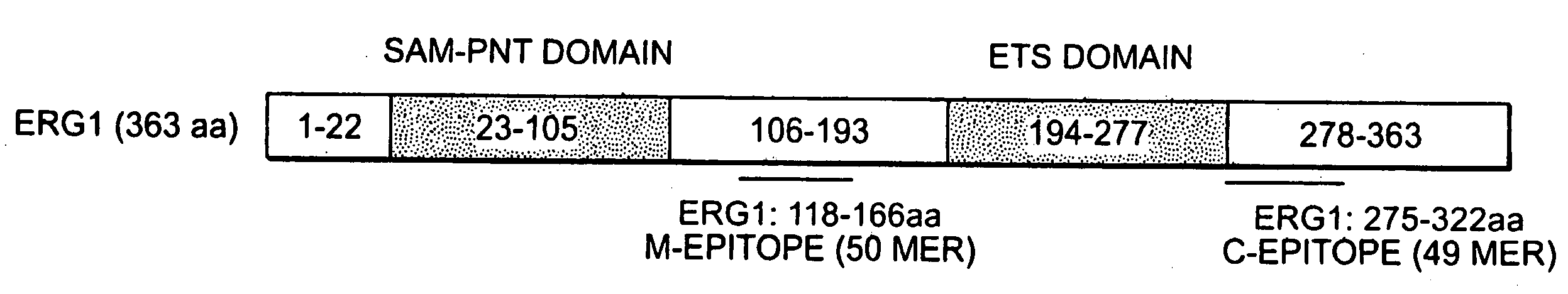 Methods of diagnosing or treating prostate cancer using the erg gene, alone or in combination with other over or under expressed genes in prostate cancer