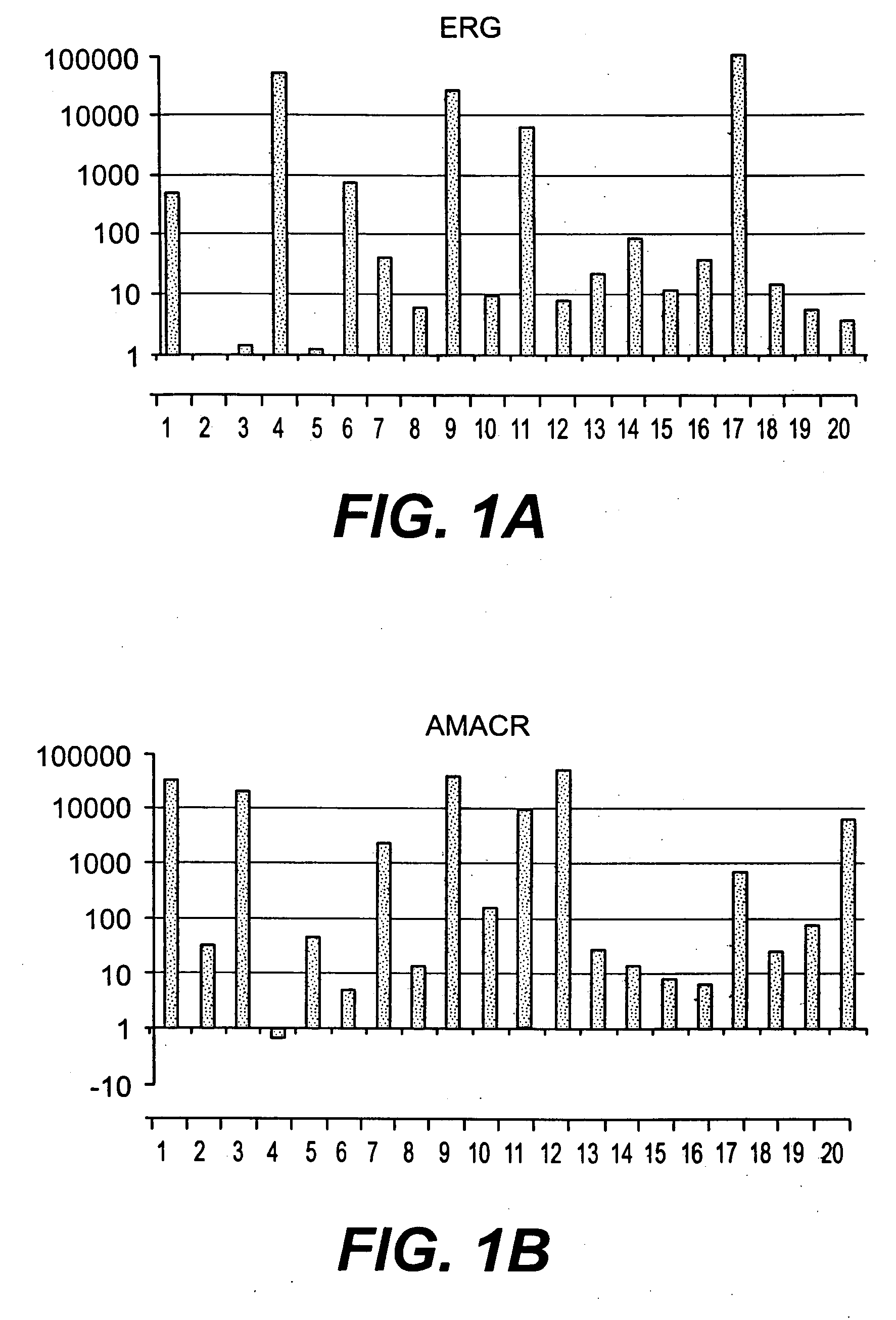 Methods of diagnosing or treating prostate cancer using the erg gene, alone or in combination with other over or under expressed genes in prostate cancer