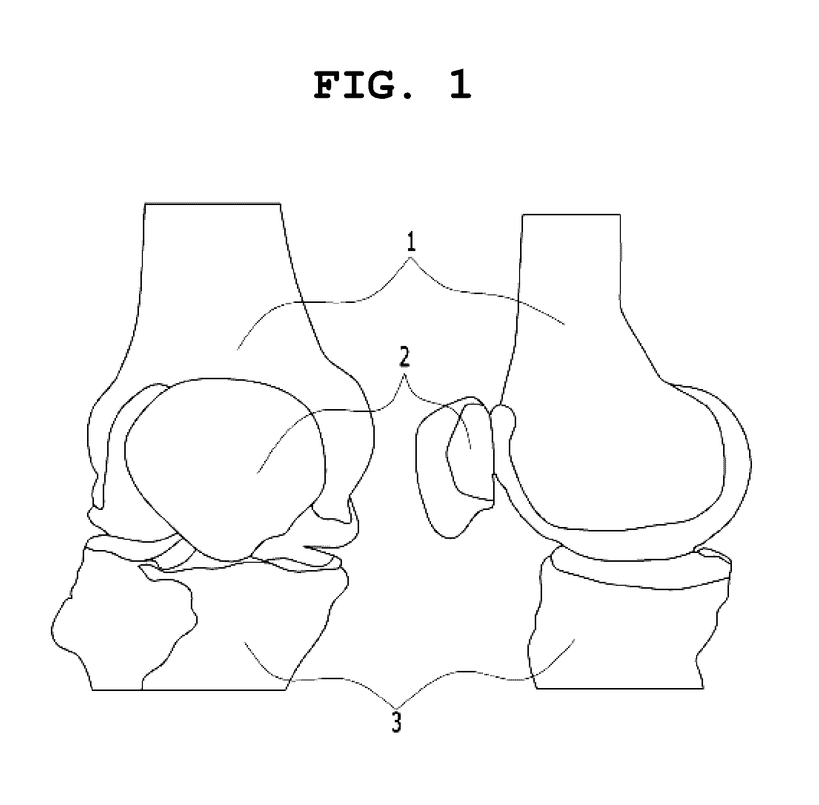 System and method for simulating reconstructive surgery of anterior cruciate ligament using medical images