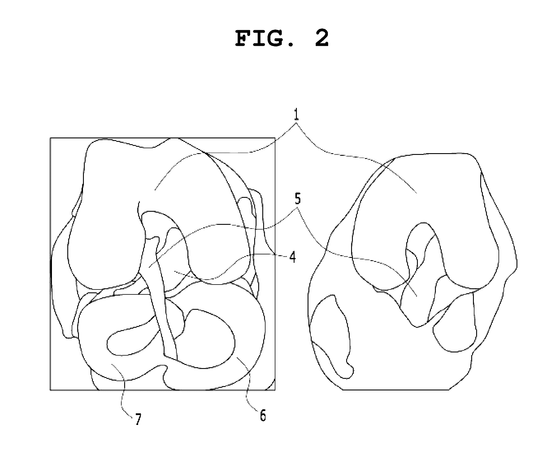 System and method for simulating reconstructive surgery of anterior cruciate ligament using medical images