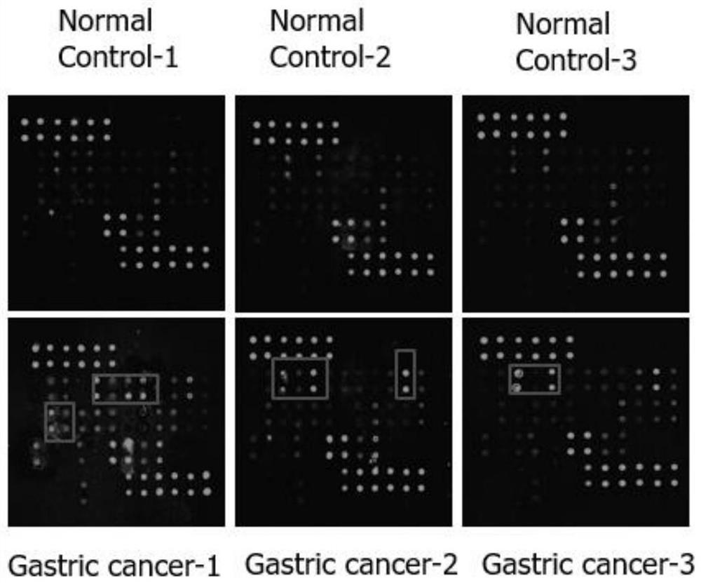 A biomarker combination for detecting gastric cancer autoantibodies and its application