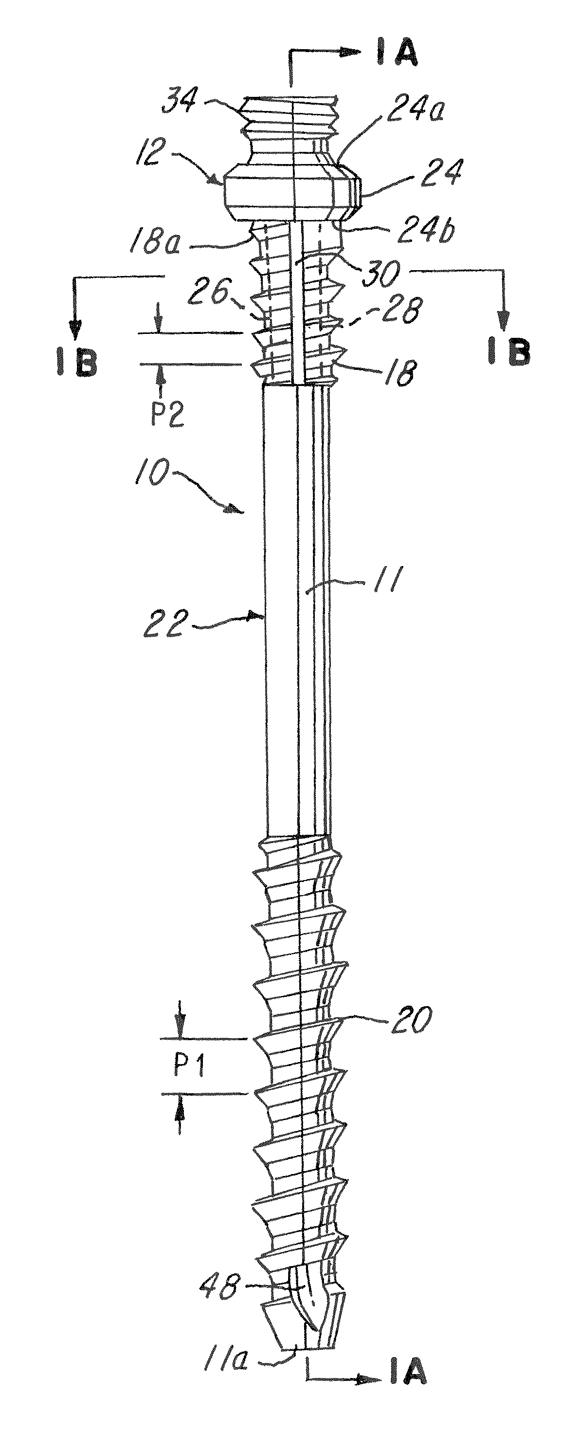 Spinal facet compression screw with variable pitch thread zones and buttress head