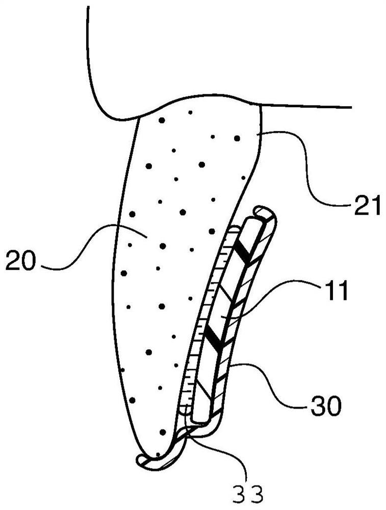 Lingual retainer