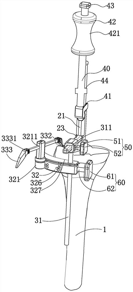 Guider for tibia osteotomy