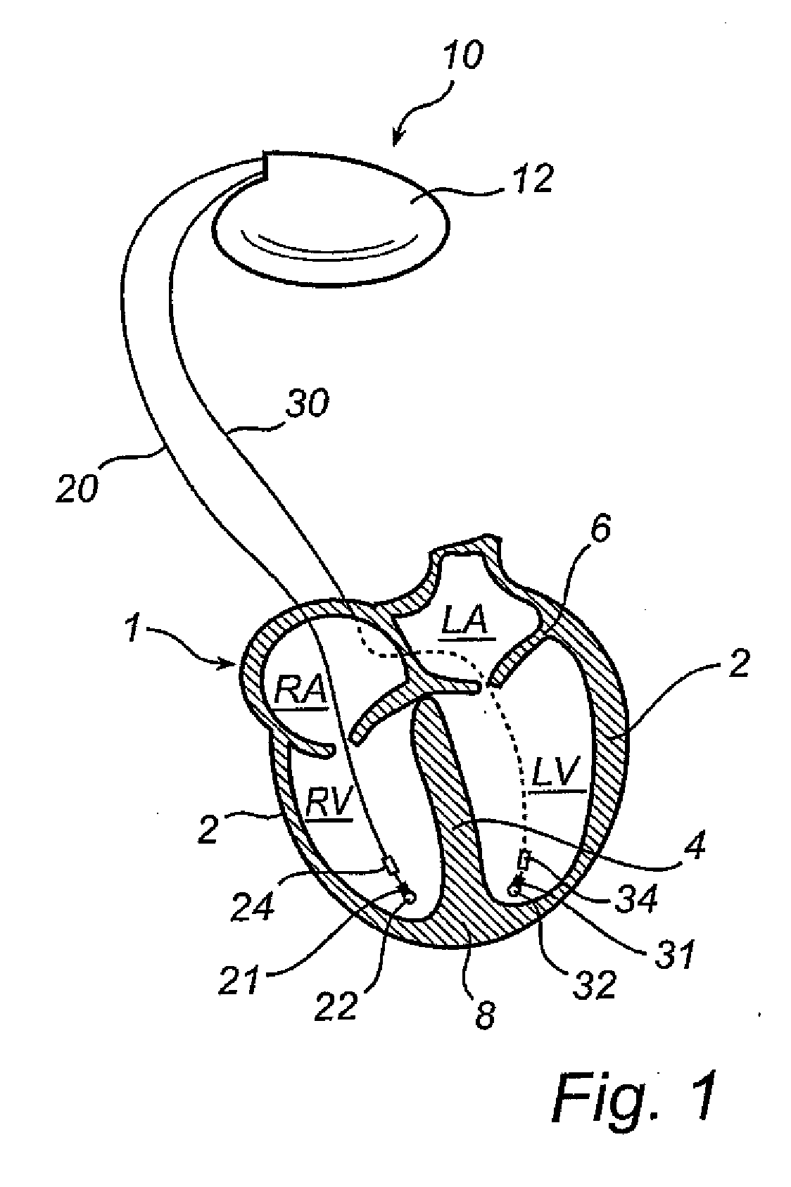 Implantable cardiac stimulator, device and method for monitoring the heart cycle in a human heart