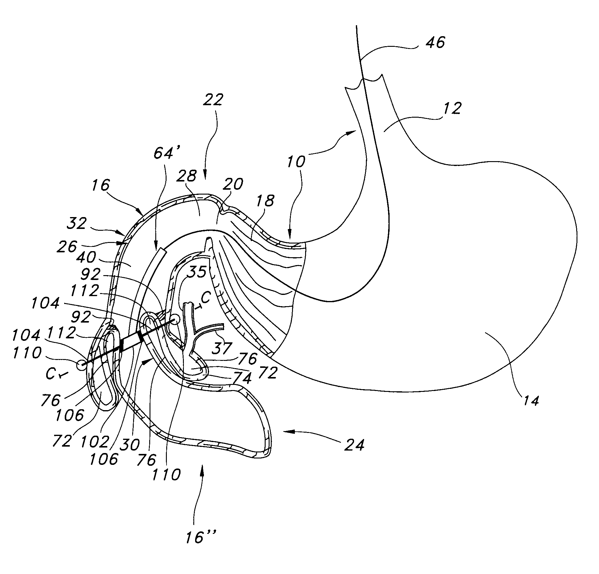 Methods of surgically modifying the duodenum