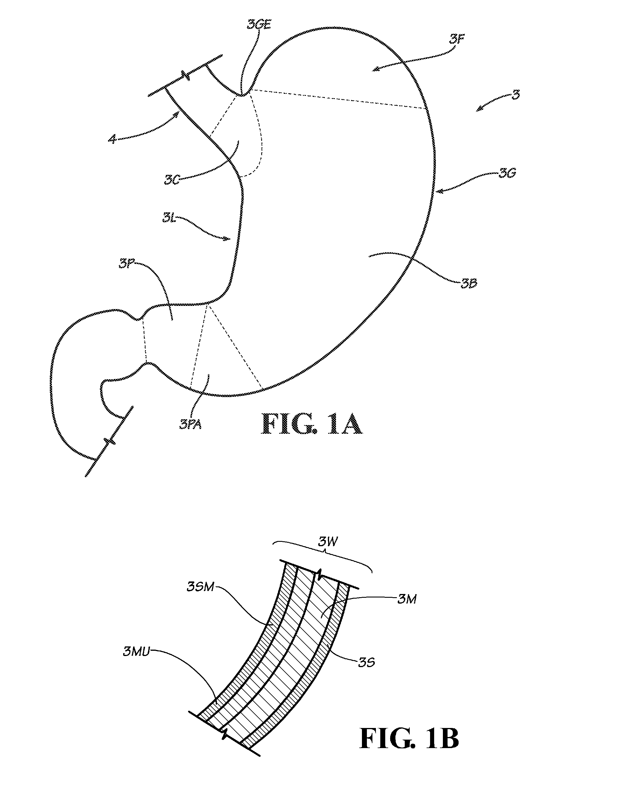 Methods, instruments and devices for extragastric reduction of stomach volume