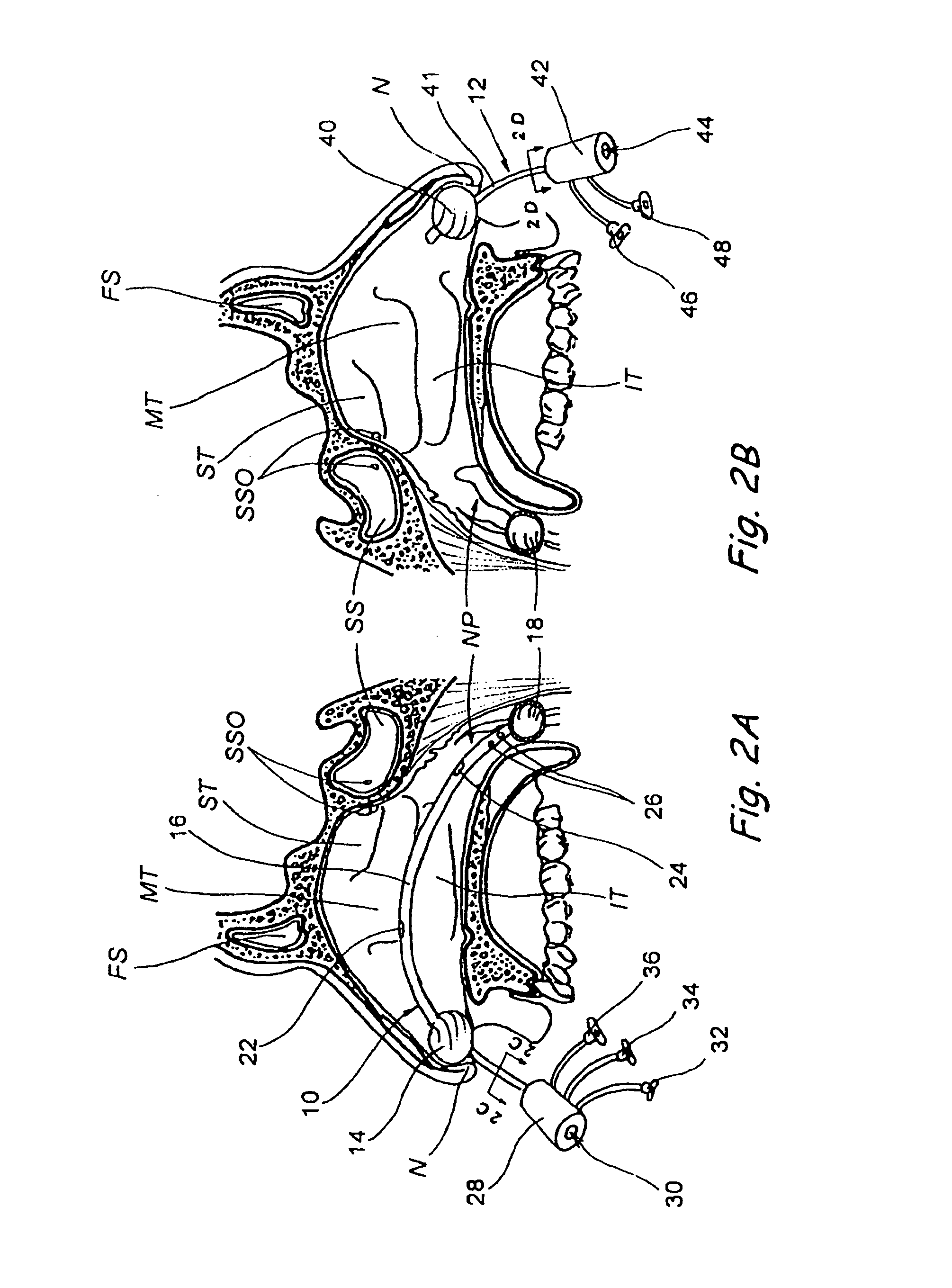 Devices, systems and methods for diagnosing and treating sinusitis and other disorders of the ears, Nose and/or throat