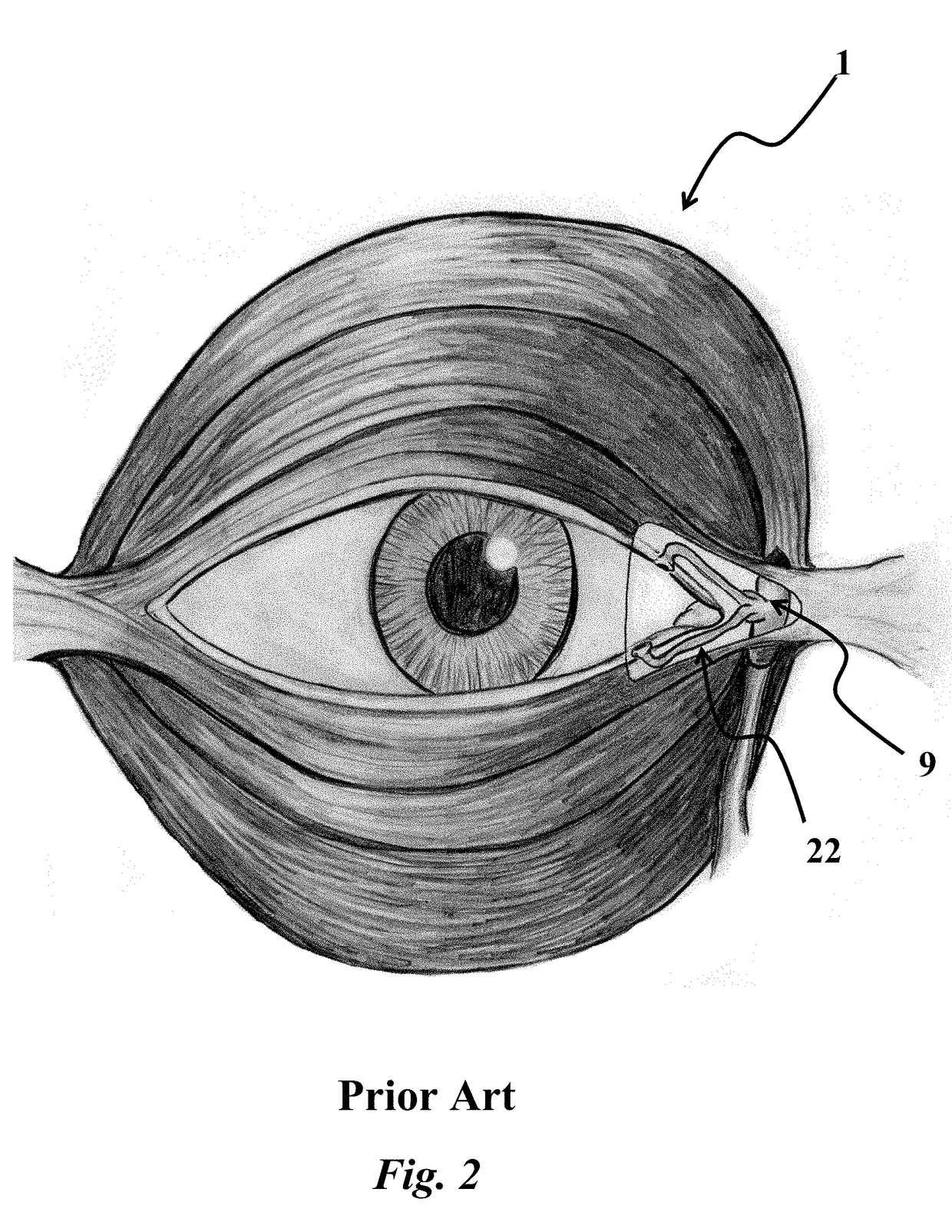 Medial orbicularis flap canthoplasty with obicularisorrhaphy