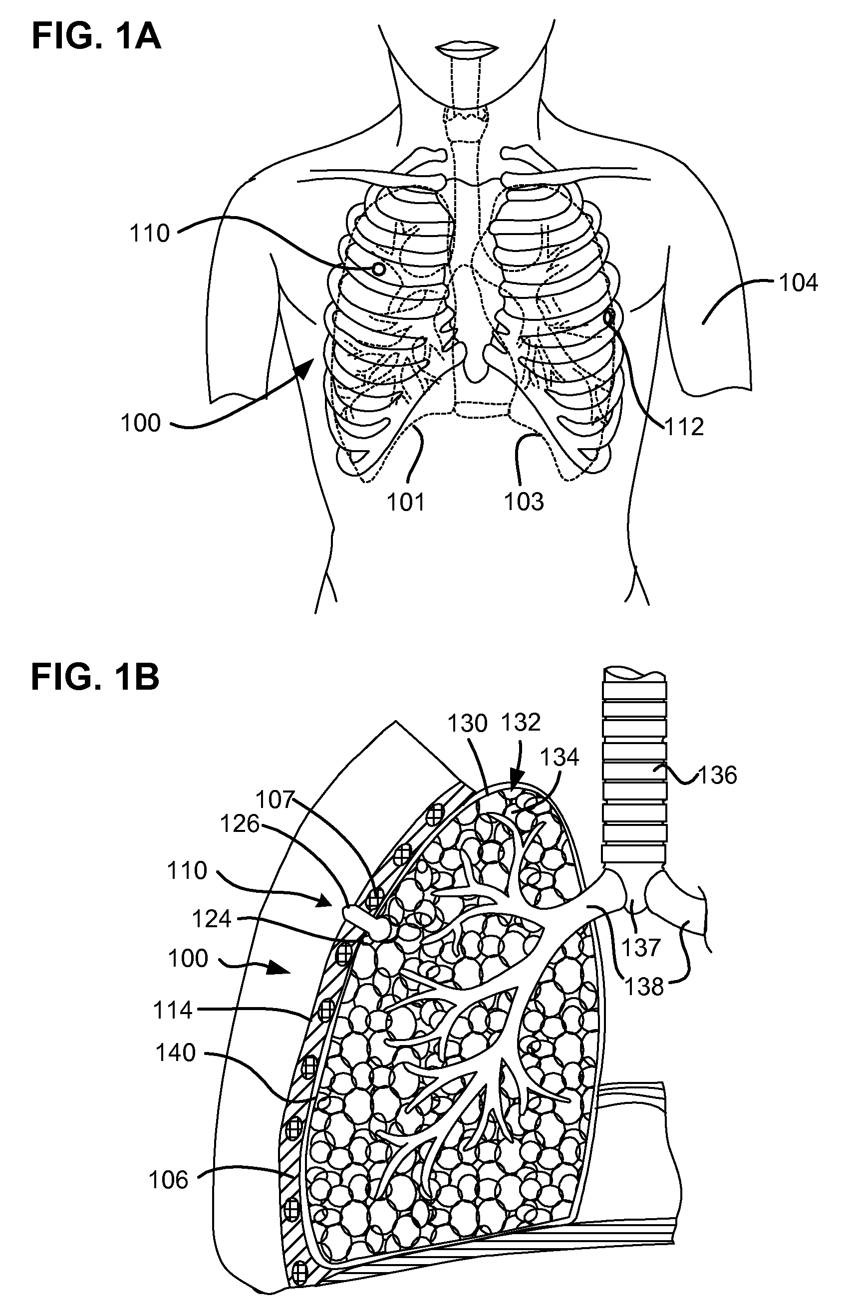 Devices and methods for delivery of a therapeutic agent through a pneumostoma