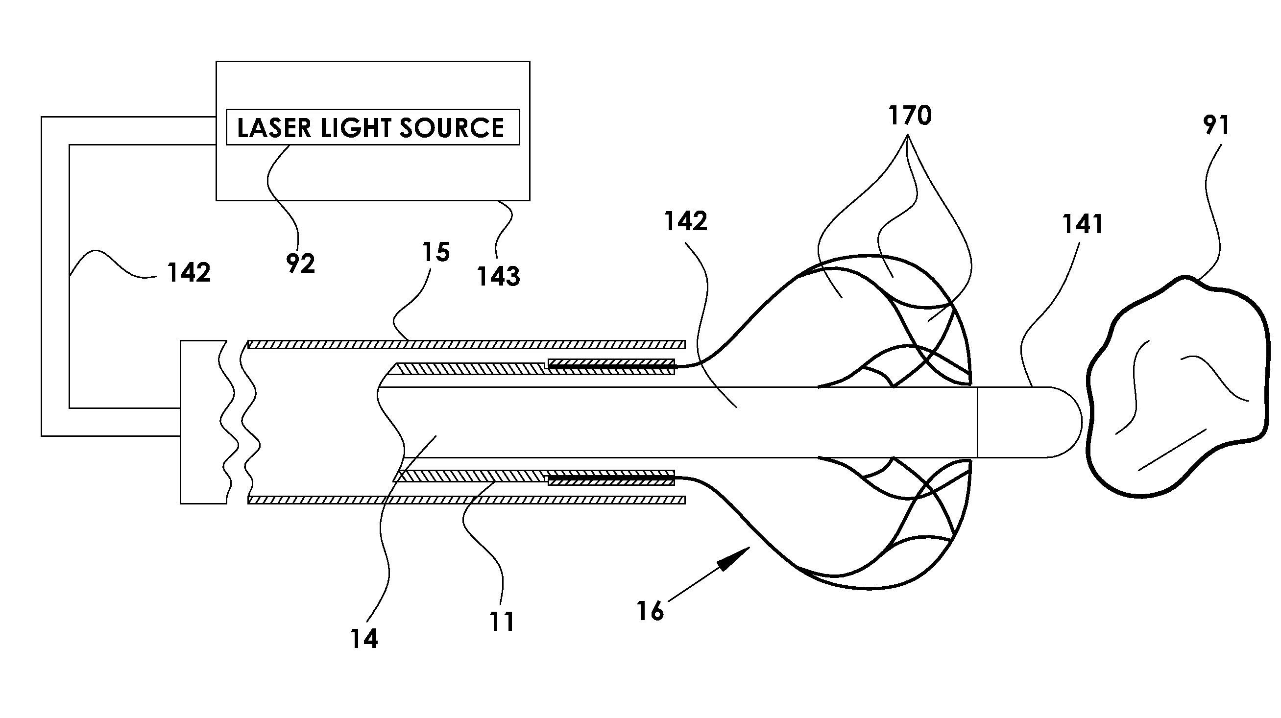Device and method for fragmenting and removing concretions from body ducts and cavities