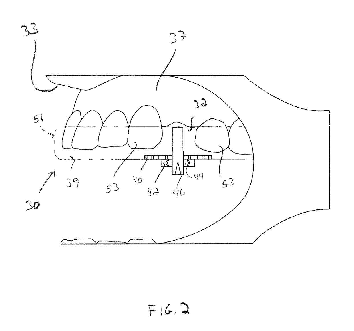 Surgical guide for dental implant and methods therefor