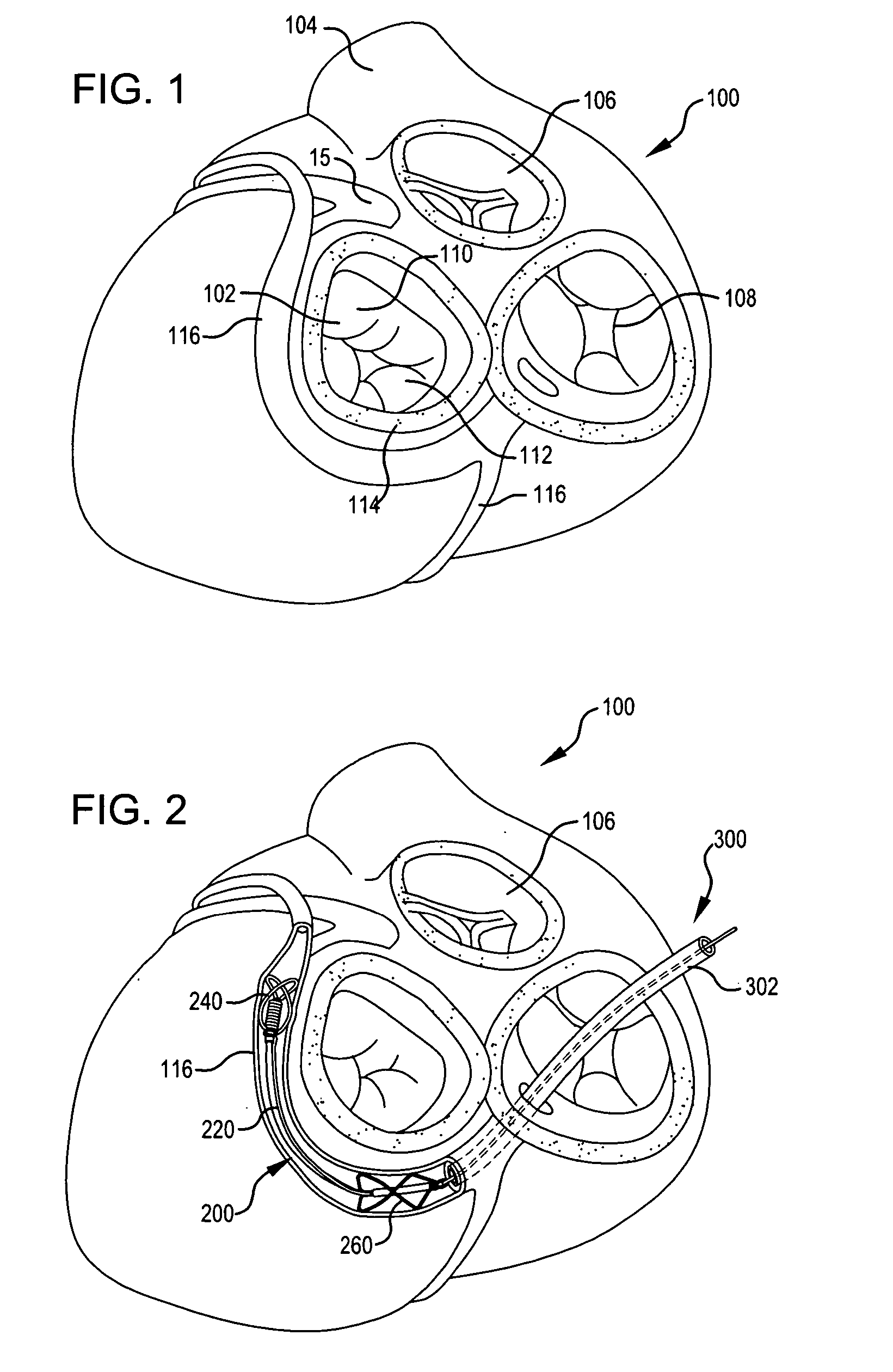 Body lumen shaping device with cardiac leads
