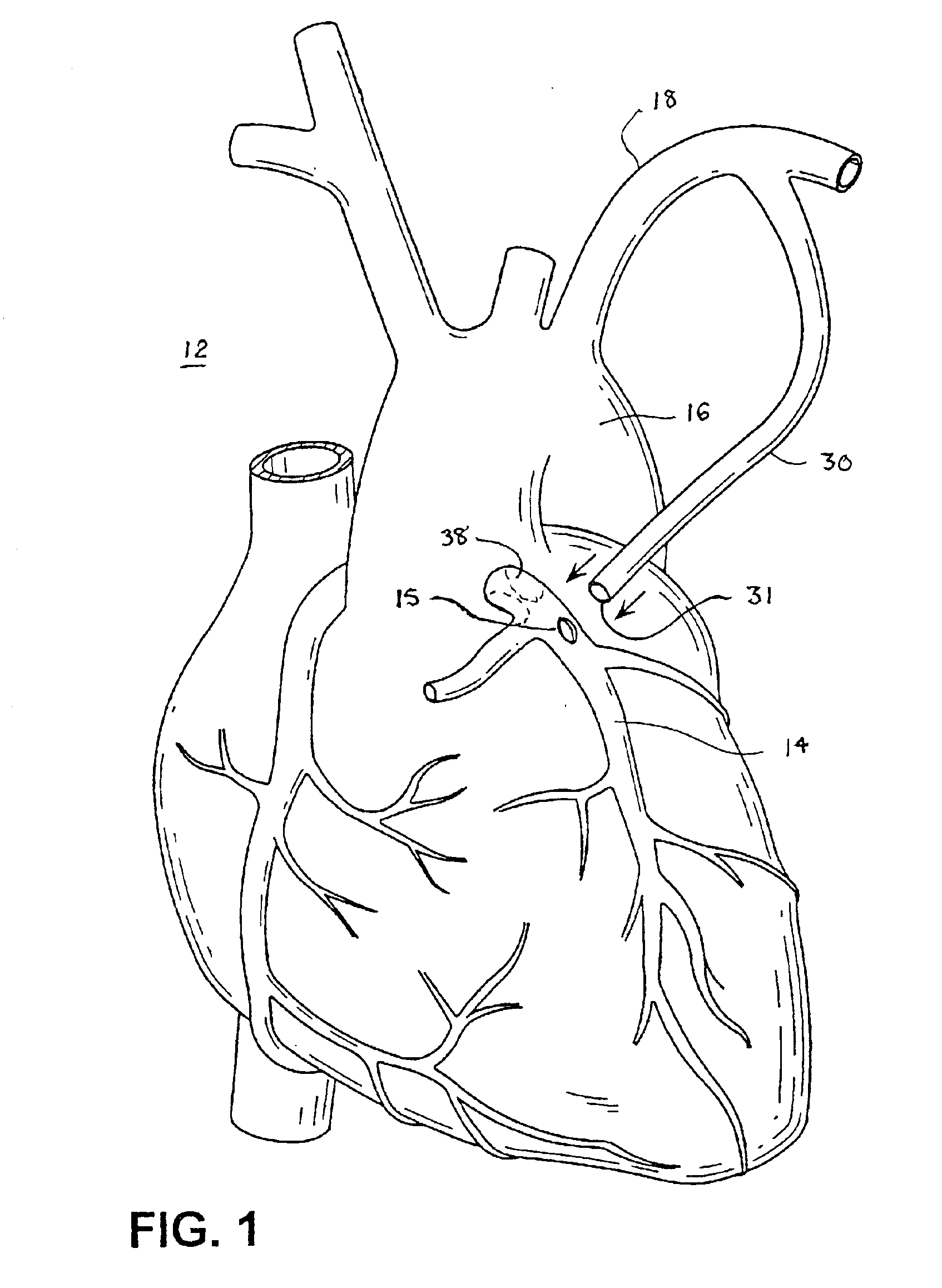 Electrosurgical methods and apparatus for making precise incisions in body vessels