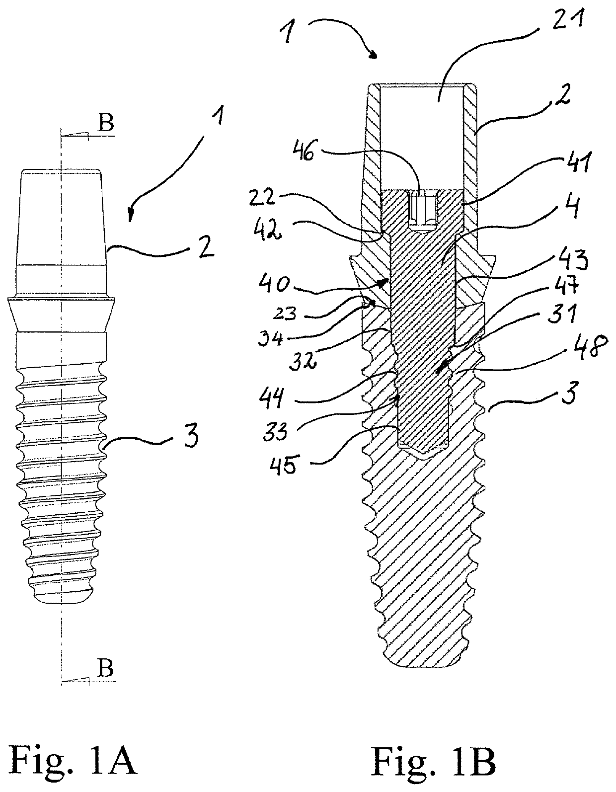 Dental prosthesis system