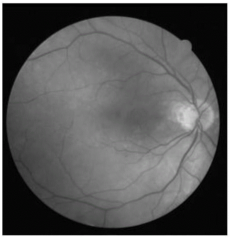 Automatic eyeground image blood vessel segmentation method based on Gabor filters