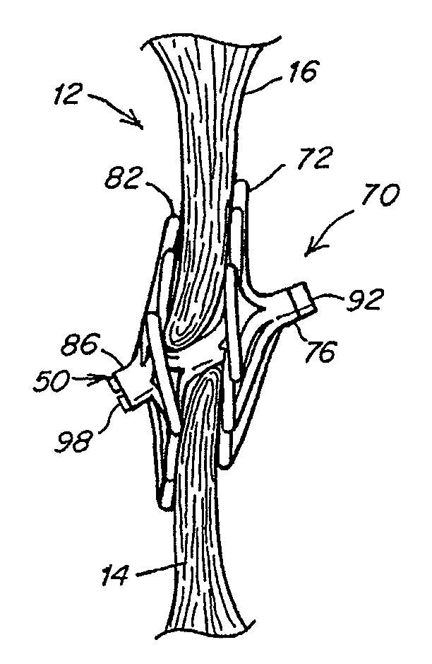 Deformable flap catch mechanism for occluder device