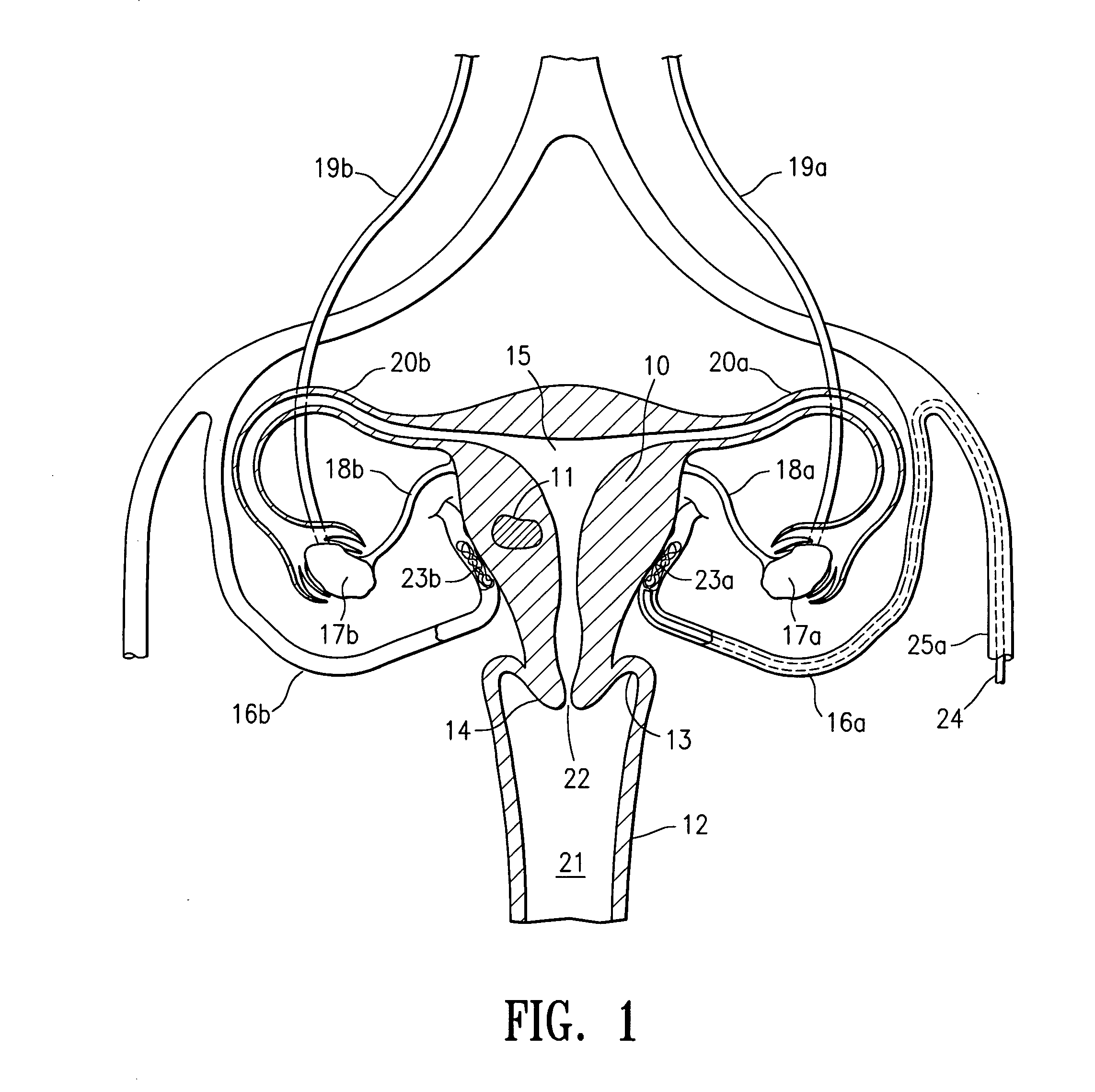 Embolic occlusion of uterine arteries