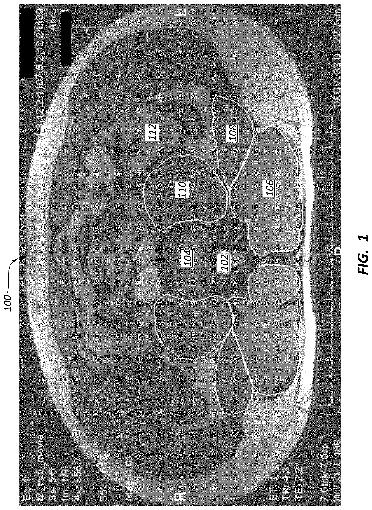 Posterior to lateral interbody fusion approach with associated instrumentation and implants