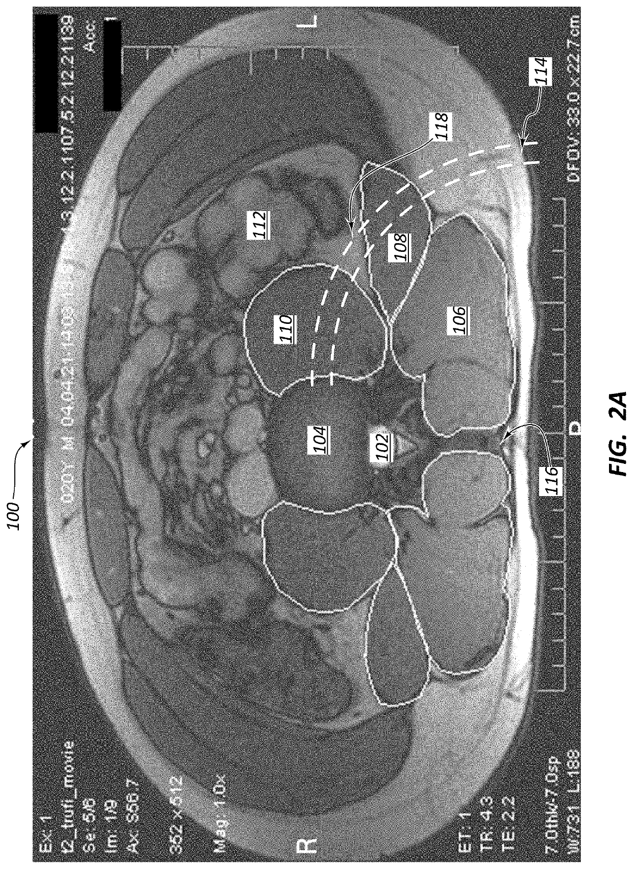 Posterior to lateral interbody fusion approach with associated instrumentation and implants