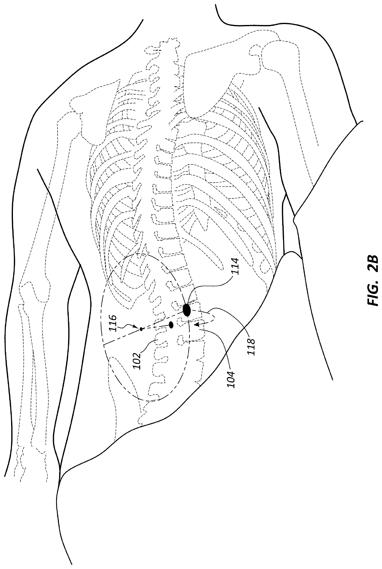 Posterior to lateral interbody fusion approach with associated instrumentation and implants