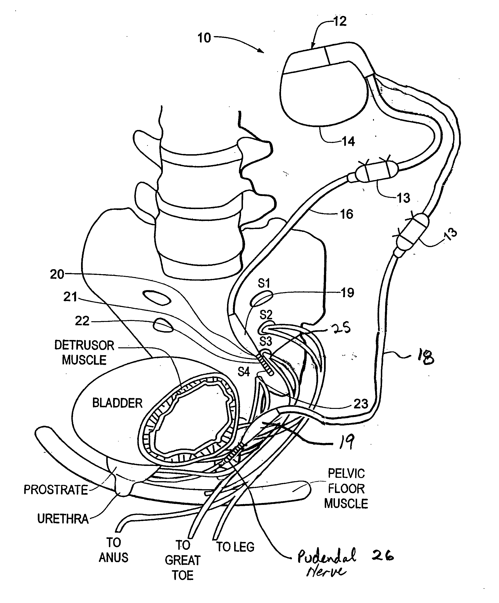 Method, system and device for treating various disorders of the pelvic floor by electrical stimulation of the pudendal nerves and the sacral nerves at different sites