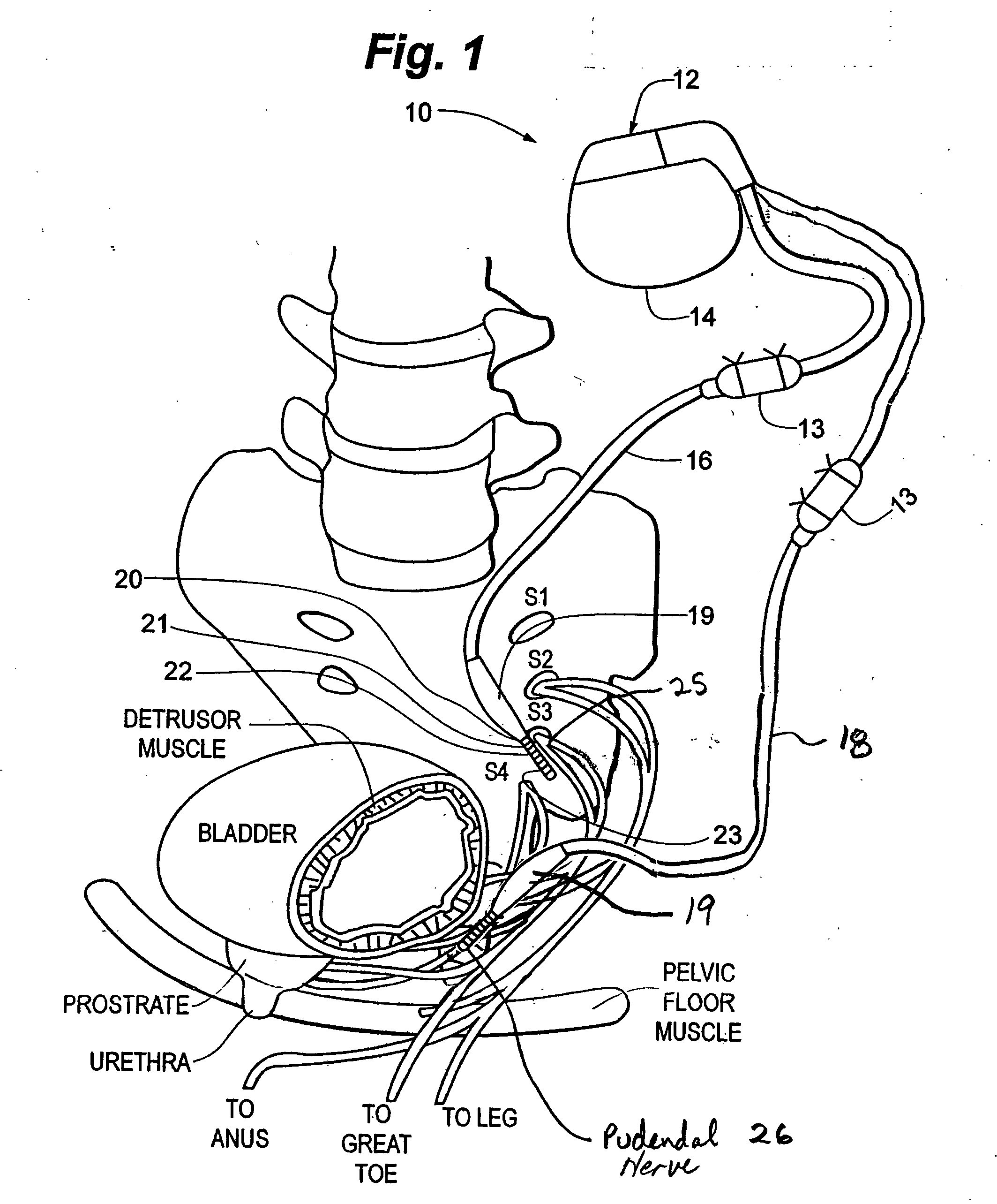 Method, system and device for treating various disorders of the pelvic floor by electrical stimulation of the pudendal nerves and the sacral nerves at different sites