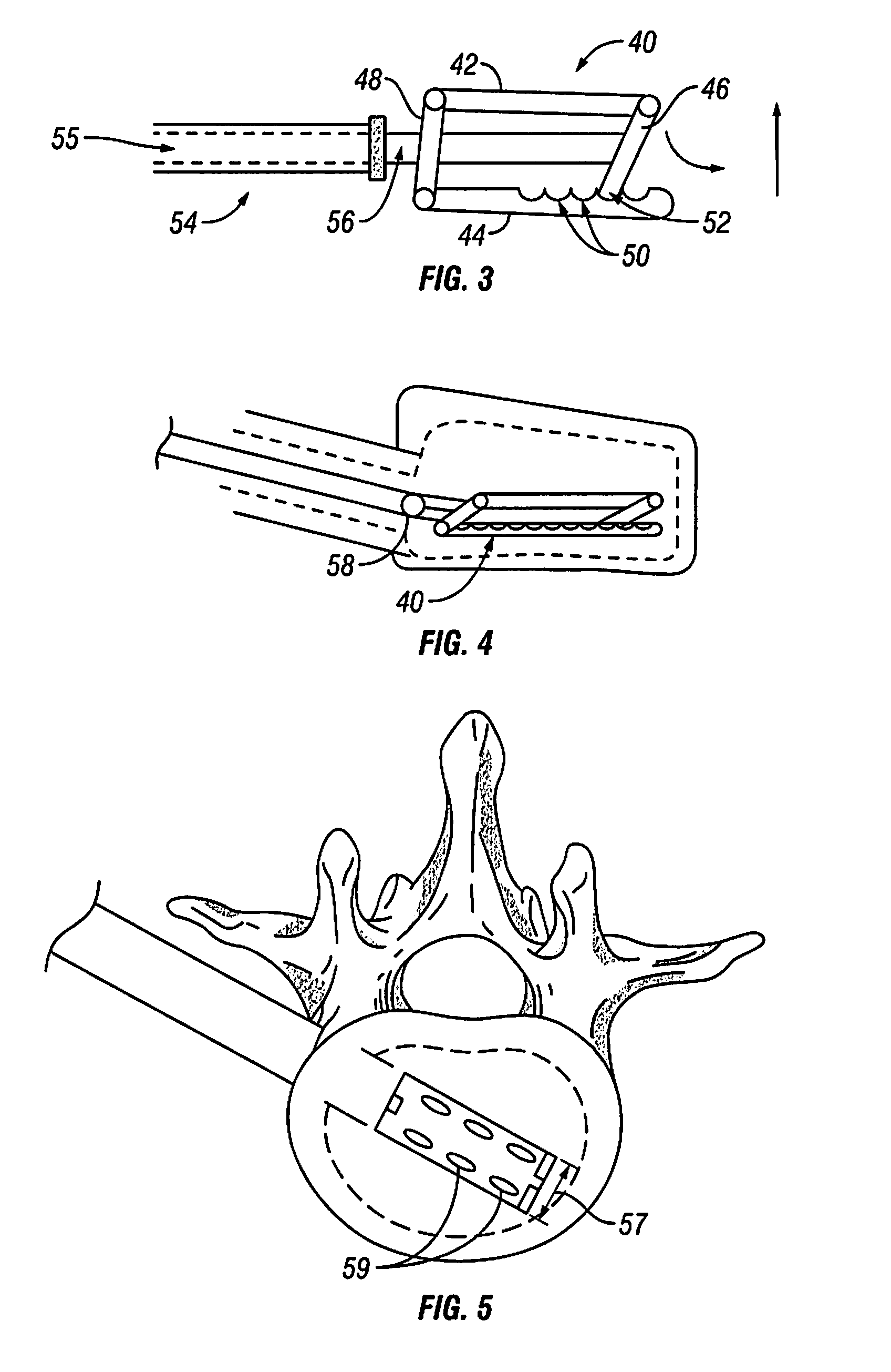 Devices and methods for treating bone