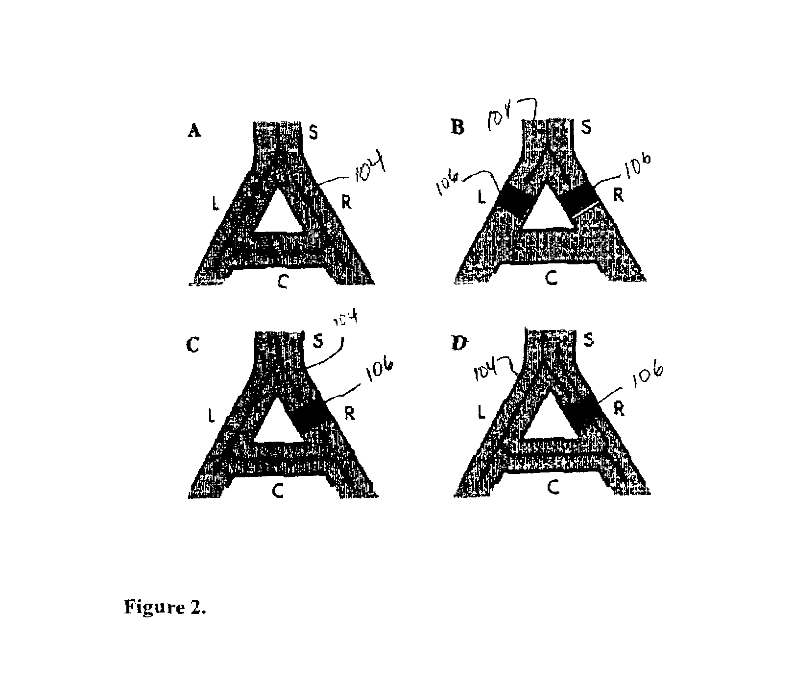 Method of and apparatus for tachycardia detection and treatment