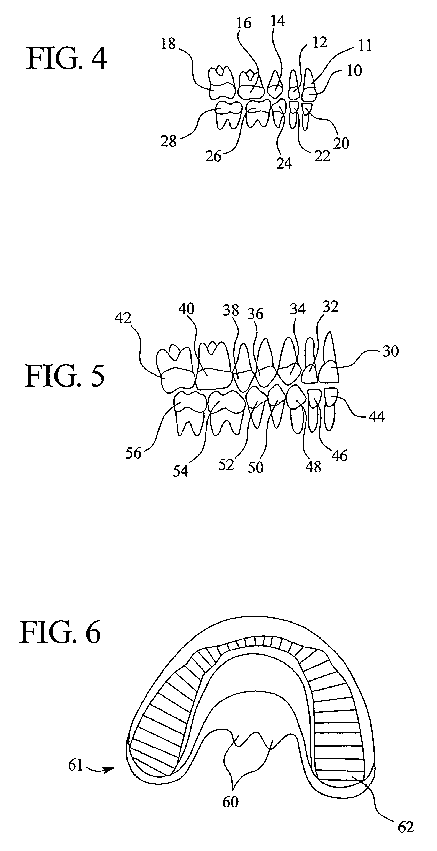 System of dental appliances having various sizes and types and a method for treating malocclusions of patients of various ages without adjustments or appointments