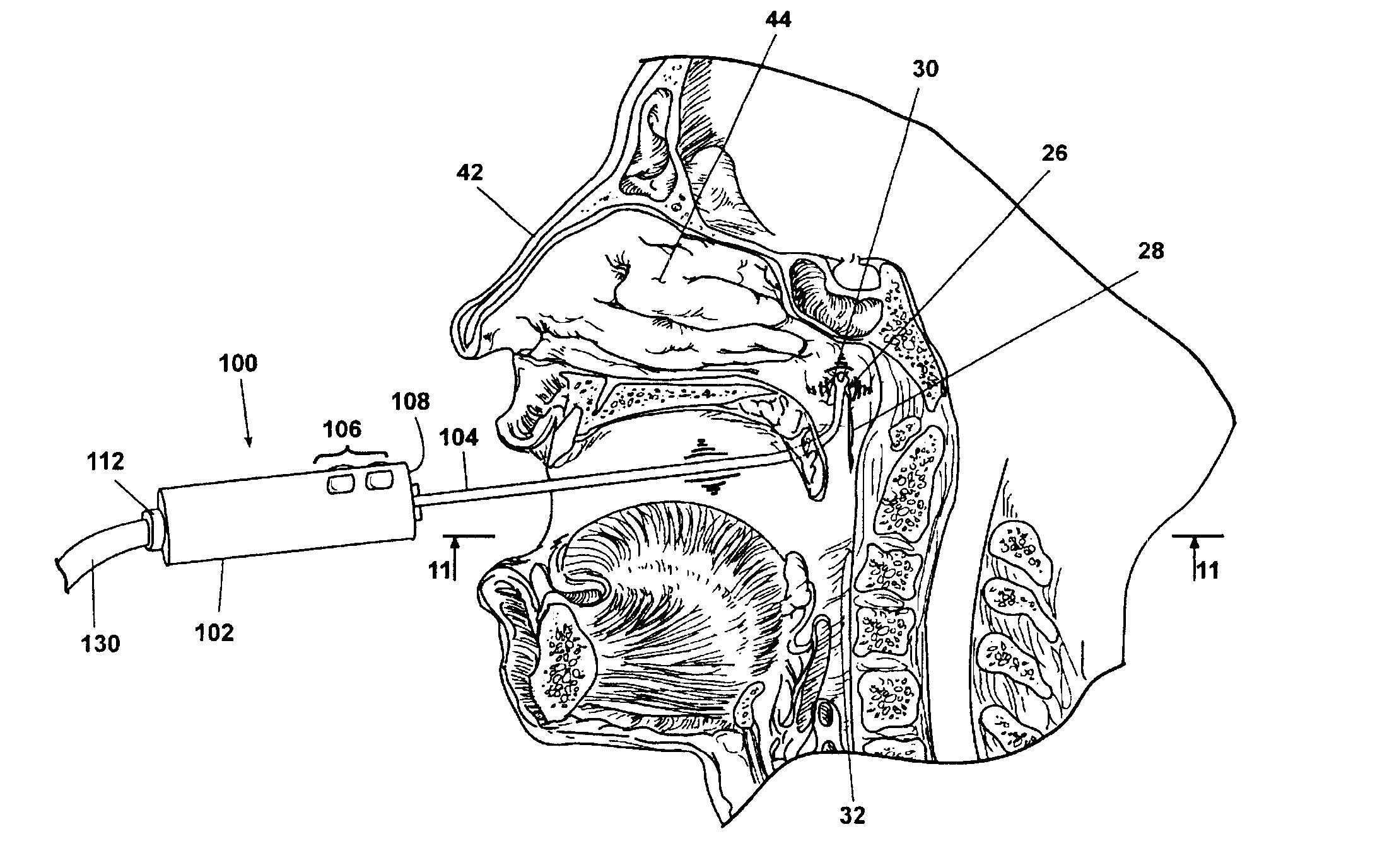 Method and apparatus for relieving fluid build-up in the middle ear