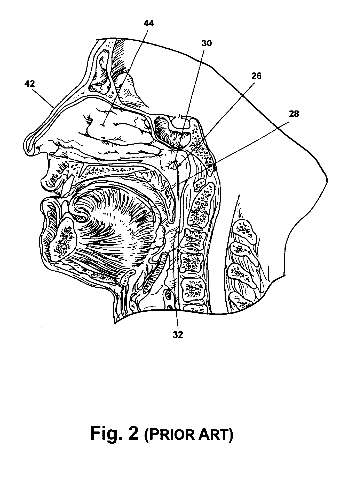 Method and apparatus for relieving fluid build-up in the middle ear