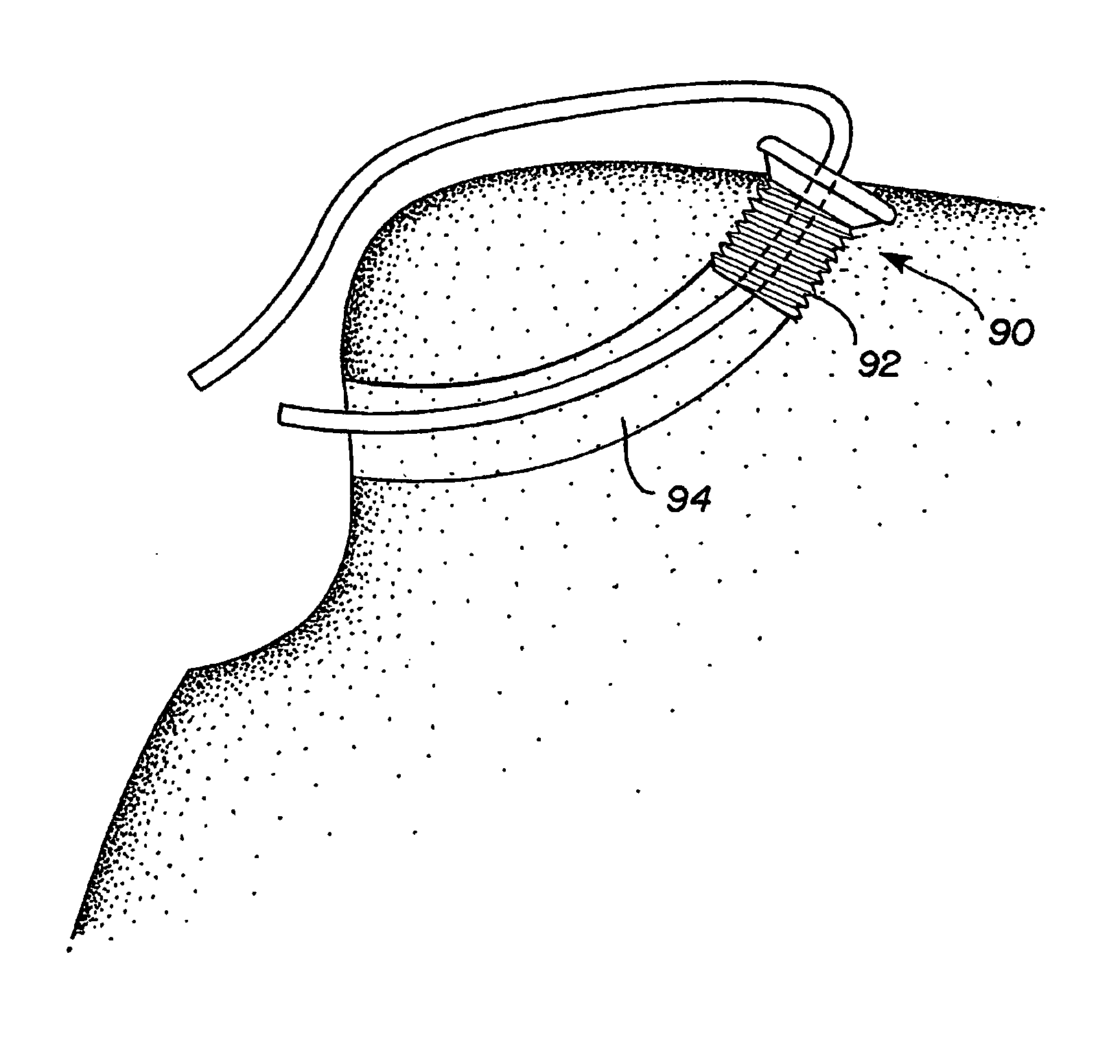 Methods and apparatus for preventing migration of sutures through transosseous tunnels