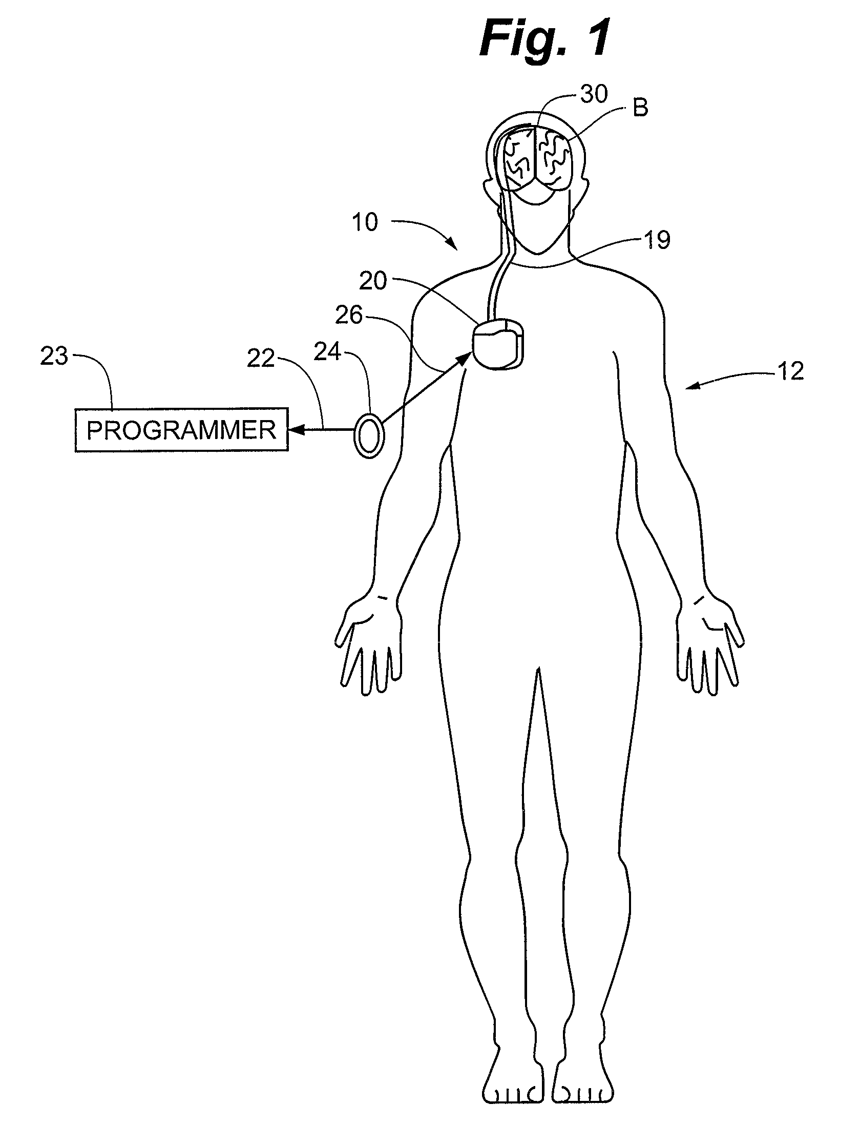 Method and apparatus for detection of nervous system disorders