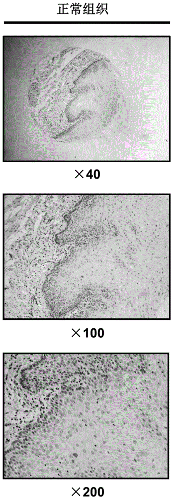 Use of the assembly inhibitor protein pfn2 in the preparation of diagnostic reagents for esophageal cancer