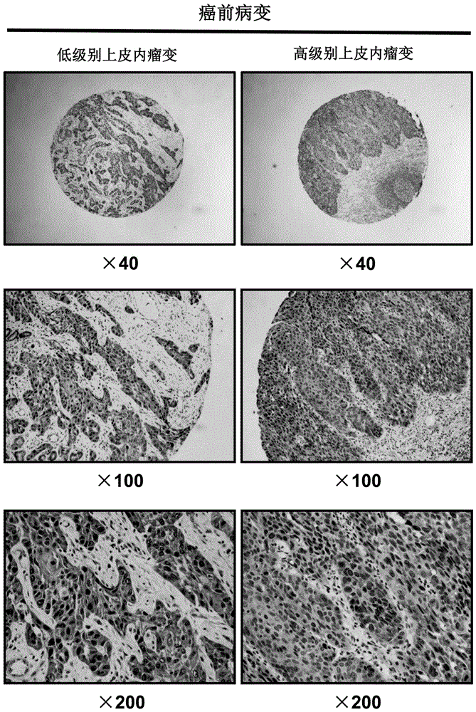 Use of the assembly inhibitor protein pfn2 in the preparation of diagnostic reagents for esophageal cancer